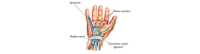 Carpal-Tunnel-Syndrome