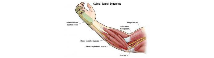 Cubital-Tunnel-Syndrome