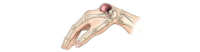 Ganglion-cysts