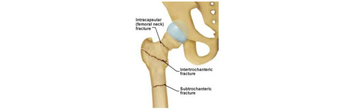 Shoulder Pain