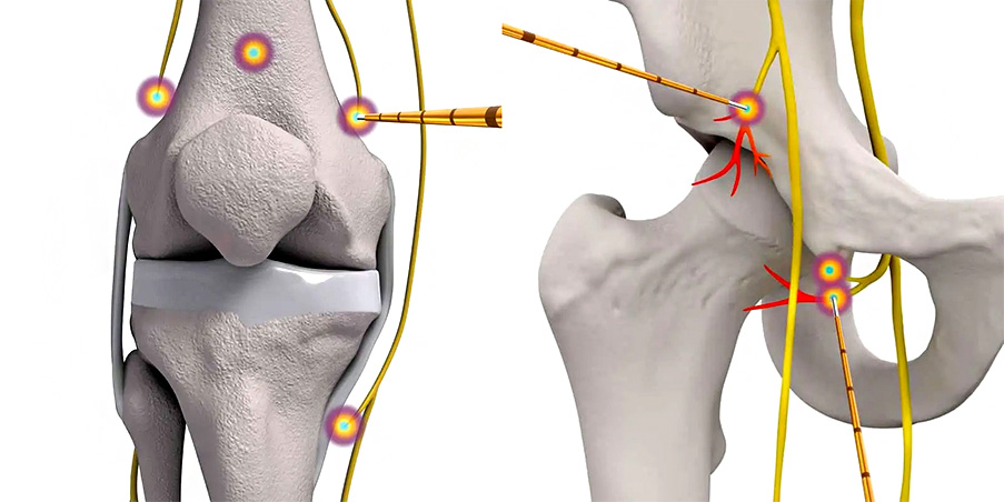 Nerve-Ablation-Procedures