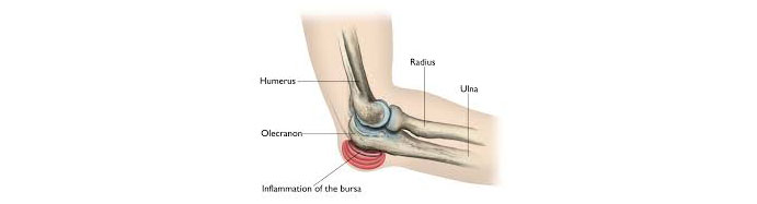 Olecranon-bursitis