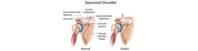 Shoulder-Separation