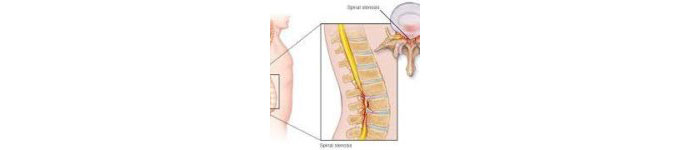 Spinal-Stenosis