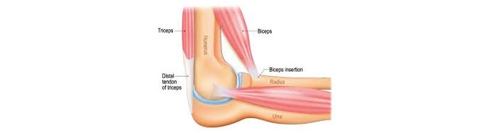 Biceps-tendonitis