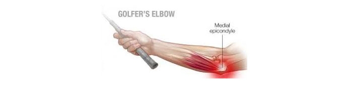 Golfer-elbow