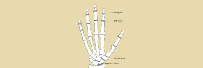 Osteoarthritis-of-the-joints-of-the-hand