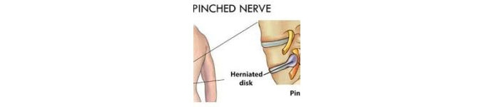 Pinched-Compressed-Nerves