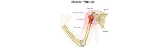 Shoulder-Fractures
