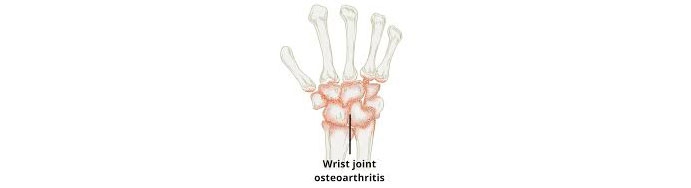Wrist-joint-Osteoarthritis